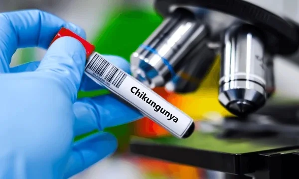 chikungunya treatment